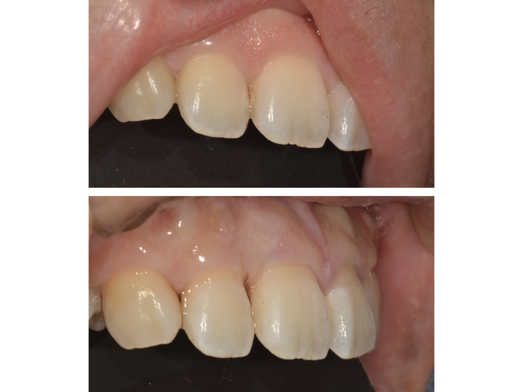 前歯の虫歯に対する精密治療を行なった一例
