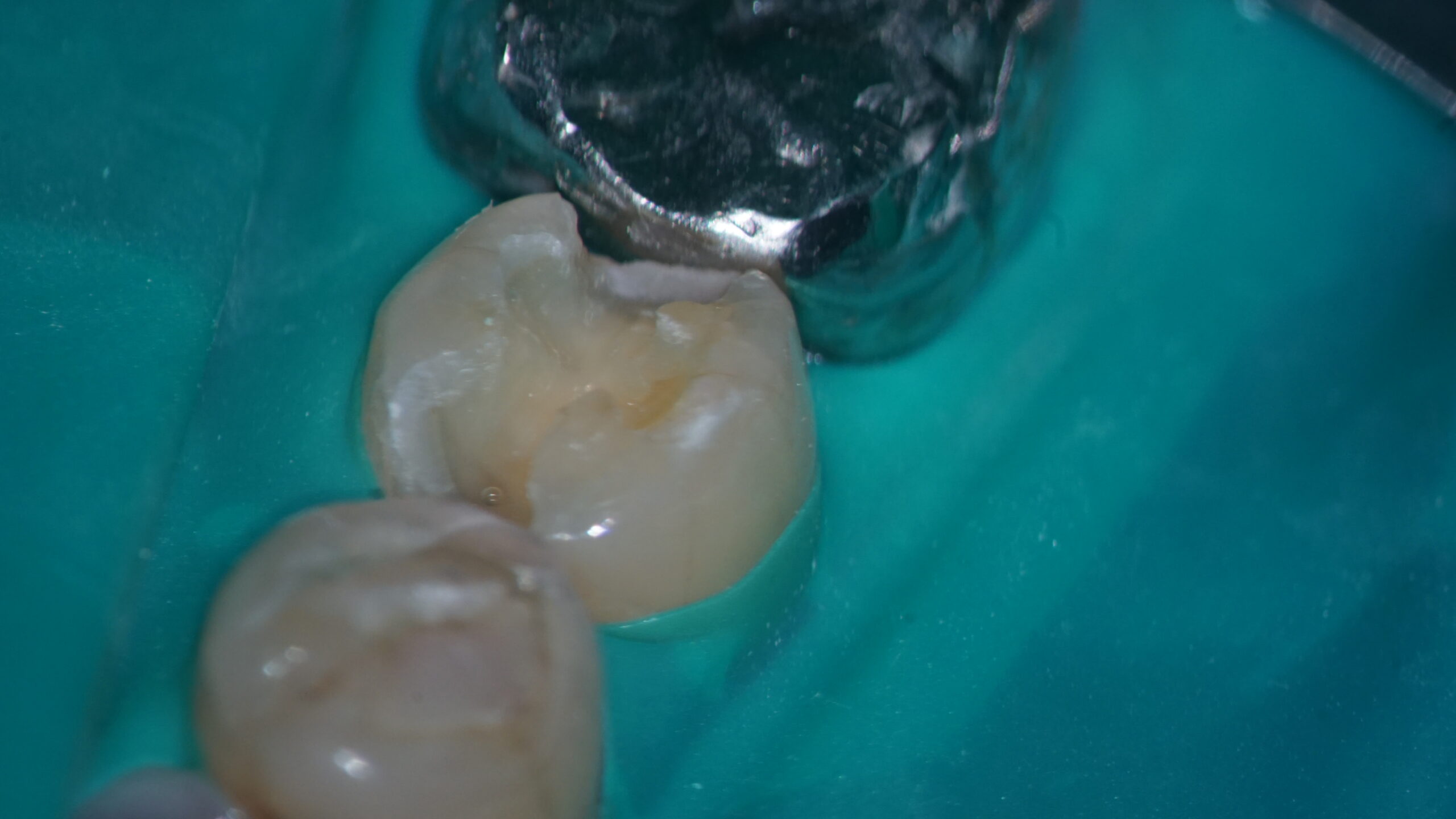 ダイレクトボンディング法での虫歯治療