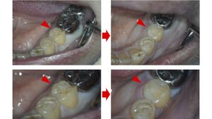 ダイレクトボンディング法による虫歯治療